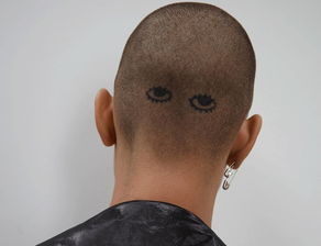 光头症难题，揭秘全新疗愈之道