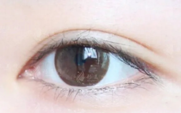 2026眼整形避坑，双眼皮与开眼角怎么选才不后悔？